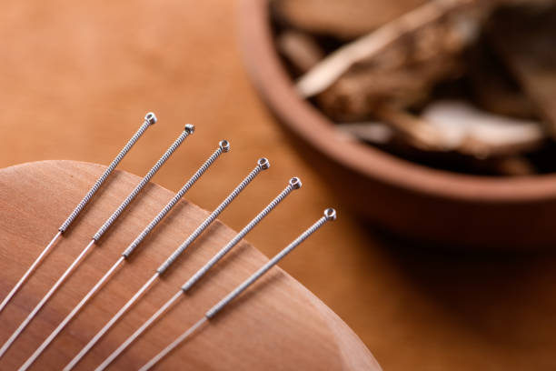 Chinese acupuncture in Melbourne